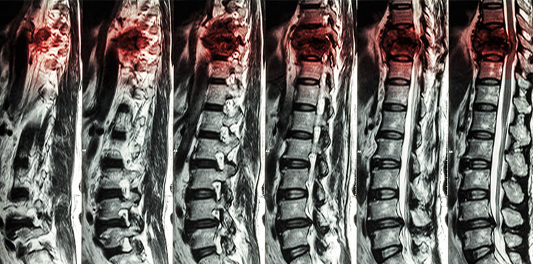 Understanding Different Types of Spinal Cord Injuries | The Krist Law ...